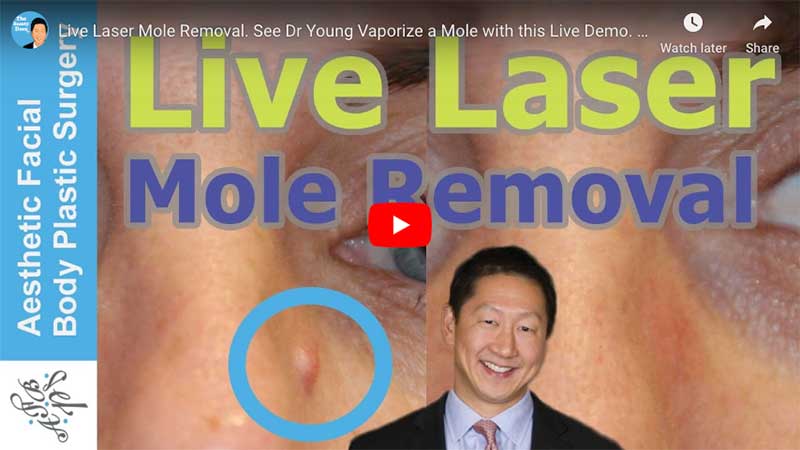 Live Laser Mole Removal. See Dr Young Vaporize a Mole with this Live Demo. Learn About Mole Removal