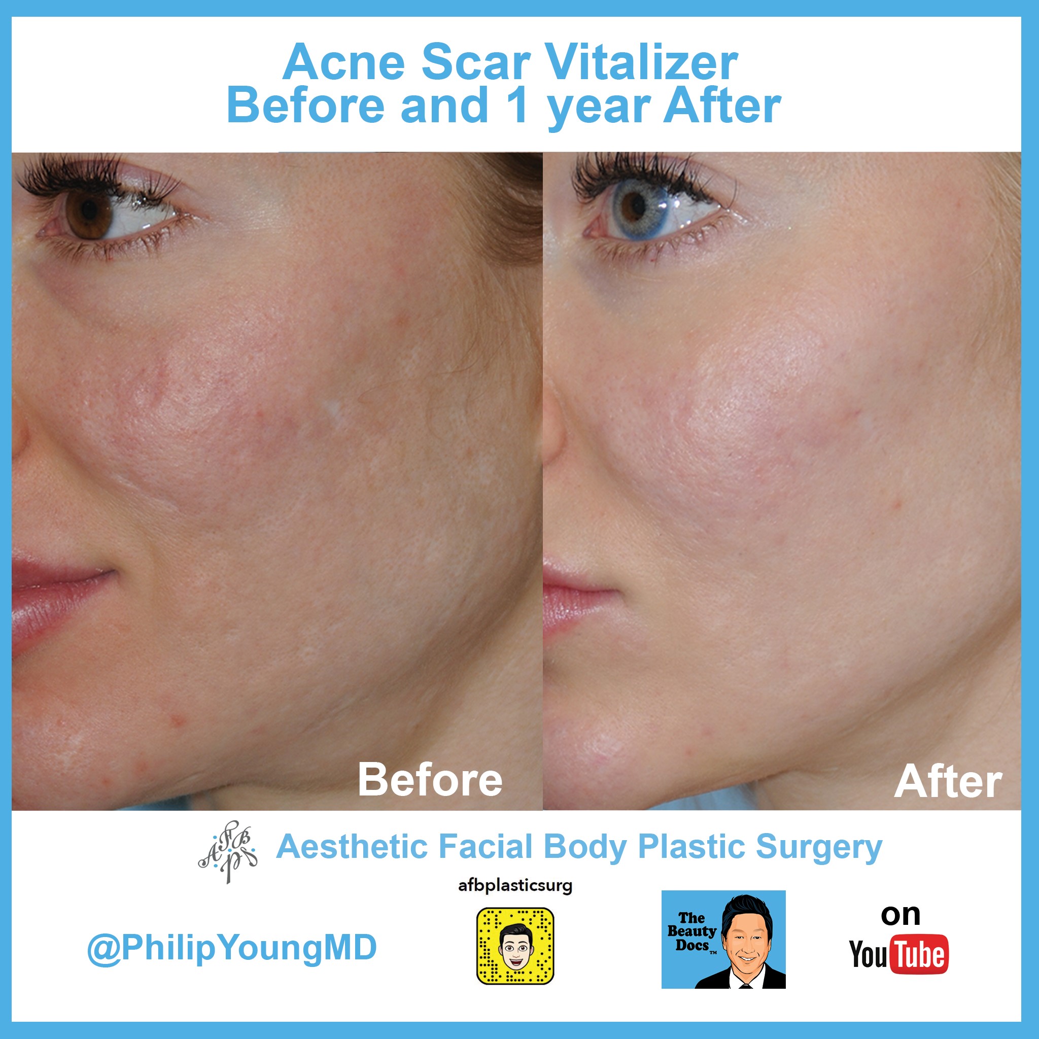 Acne scars Before and After